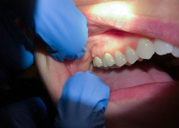 Best Dental Abscess Treatment in Brooklyn, IA
